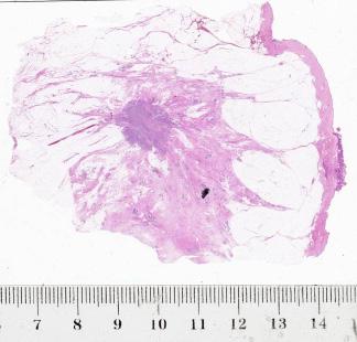 distortion, (both duct forming invasive carcinoma and diffusely infiltrating