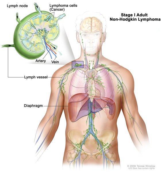 Lymphoma is cancer that begins in infection-fighting cells of the immune system, called lymphocytes.