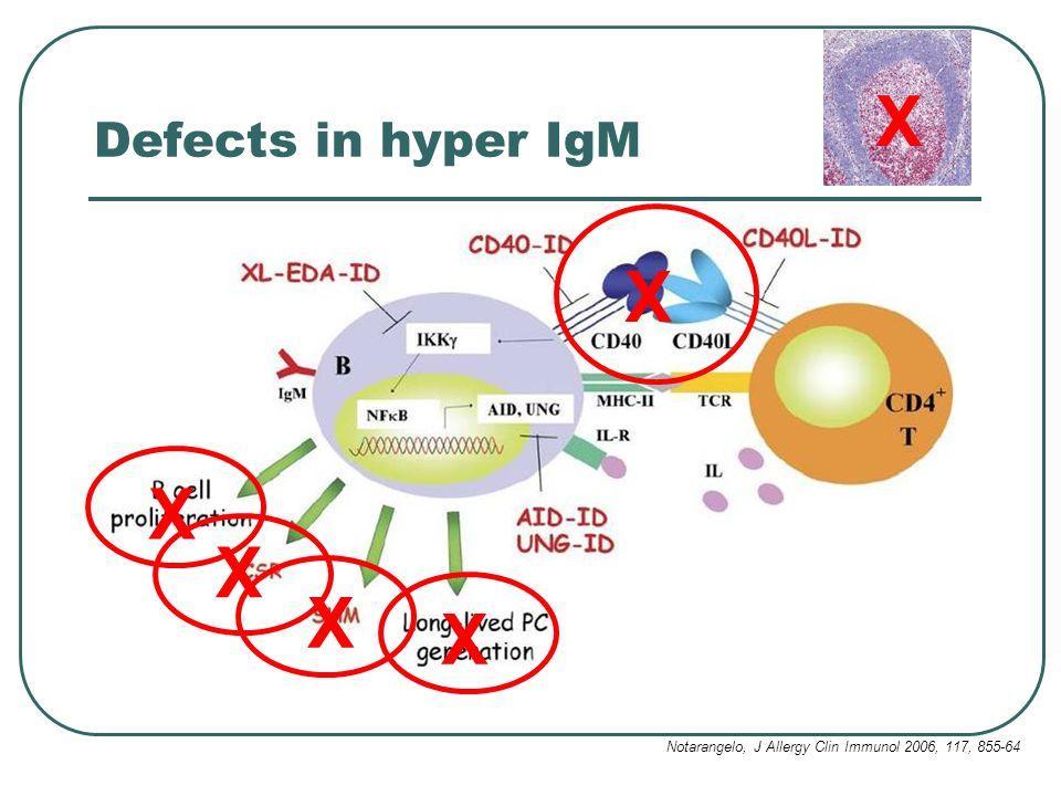 Hyper- IgM Syndrome Due to mutated CD40L (on helper t cells) or CD40 receptor (on B cells). 1. Second signal cannot be delivered to helper T cells during B cell activation. 2.