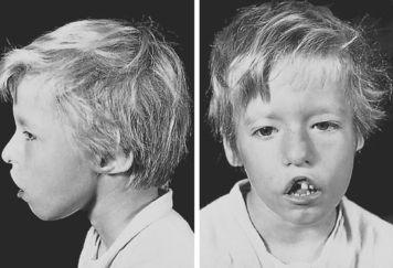 DiGeorge syndrome Due to 22q11 microdeletion Developmental failure of