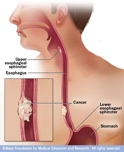 Example: Esophageal cancer Risk factors: alcohol