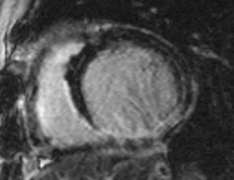 Clinical case 1: CMR for viability assessment