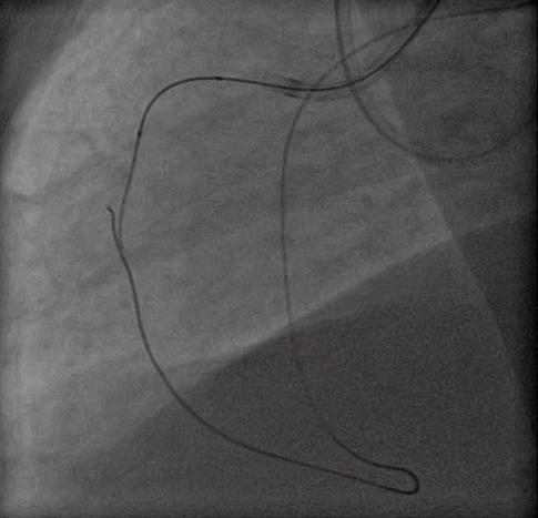 Case 3: CMR for Complications Assessment Retrograde approach via the septal collaterals