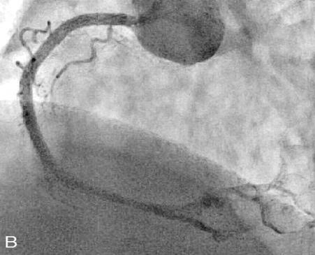 Case 3: CMR for Complications Assessment Retrograde approach via the septal collaterals