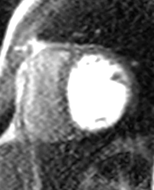 Case 5: CMR for Assessment of Viability and