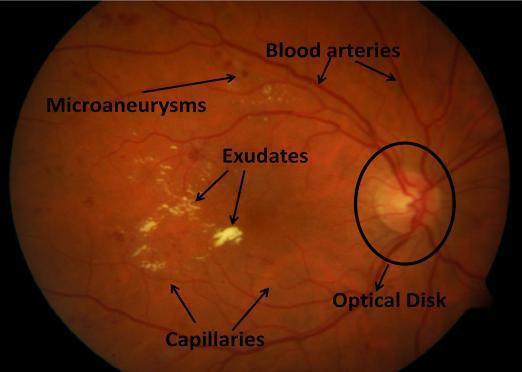 This is the early stage. Tiny blood vessels may leak which makes the retina swell. Swelling of macula is macular edema which is a reason for people with diabetes have vision loss.