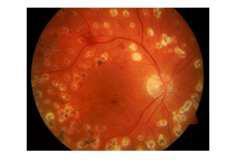 the publically available Messidor database where AUC approximately 90% is achieved. 5.2 Hemorrhages DR advances retinal haemorrhages arises.