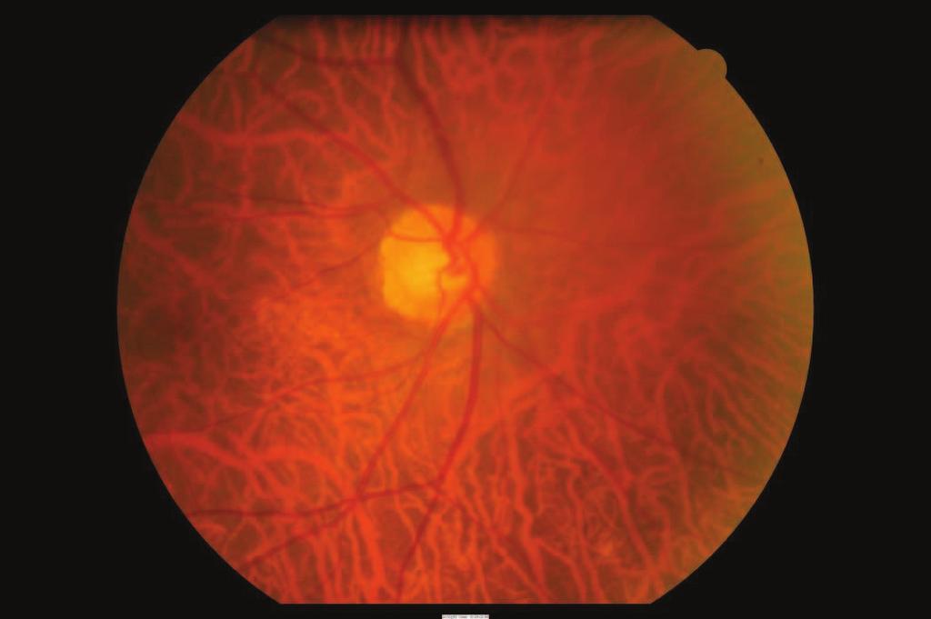 26 M Xu et al arcade vessels and the fovea [2] These choroidal vessels are well-defined and can be clearly observed Fig 1 shows some standard images with tessellated fundus Currently, the detection