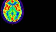 PET imaging in neurodegenerative disease PET imaging agents for neurodegenerative diseases have a significant impact on clinical diagnosis and patient care.