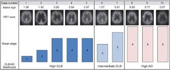 DLB hypometabolism pattern in PET DLB pattern: 14 patients 71% showed hypometabolism in the posterior brain