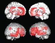 bv FTD: prevalent involvement of the anterior cingulate cortex,