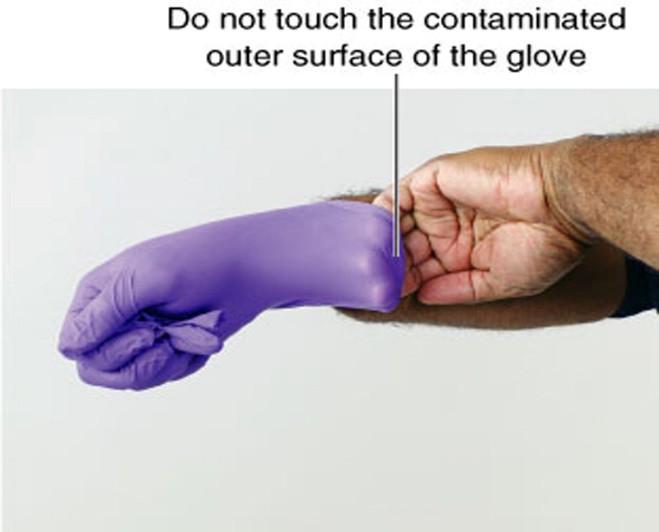 Skill: Removing Contaminated Gloves continued 3.