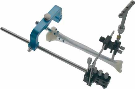 On completion of proximal interlocking, remove the upper part of the proximal targeting device by undoing the adapter screw with a wrench from the basic instrument set.