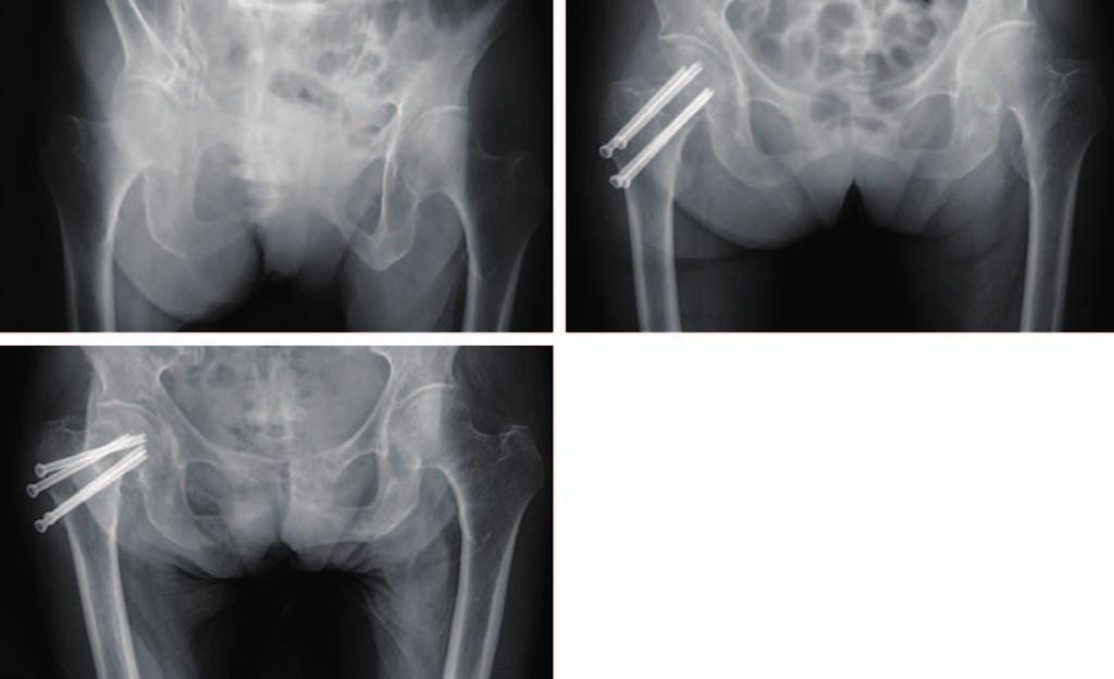 Hip Pelvis 26(4): 263-268, 2014 fixation has been widely used to treat valgus impacted femoral neck fractures.
