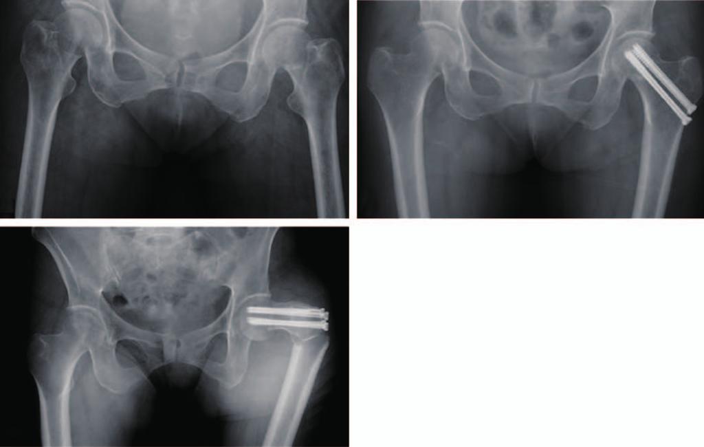 Yoon-Chung Kim et al. In Situ Pinning for Femoral Neck Fractures in Elderly (18.2%) out of the 33 studied patients.