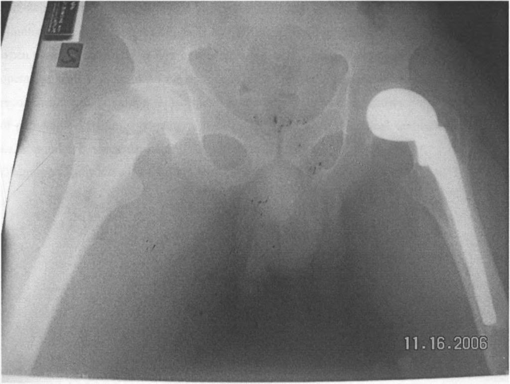 X-ray showing fracture neck of femur fixed with hemiarthroplasty Bipolar (biarticular) replacement arthroplasty, this is a modification of hemiarthroplsty in which the femoral head