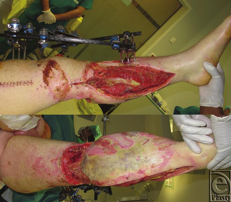 PAUCHOT ET AL CASE REPORT A 38-year-old man had both his lower limbs caught by an agitator-mixer, which required amputation of the lower third of the right leg.