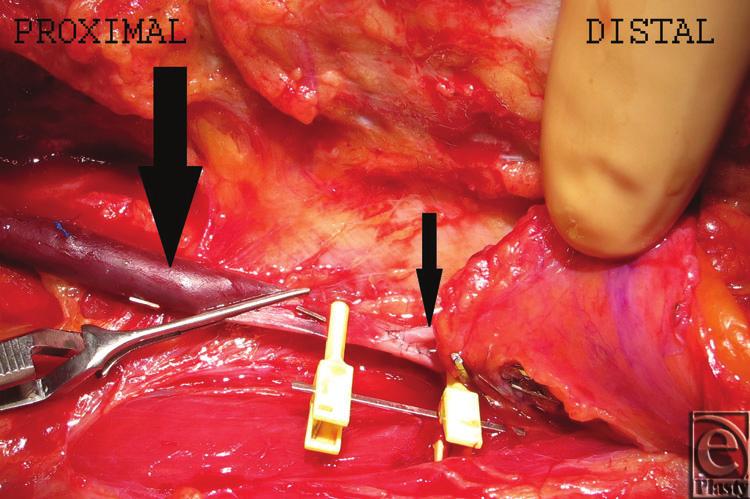 eplasty VOLUME 15 Figure 2. End-to-side arterial anastomosis between the right gastroepiploic artery (small arrow) and saphenous vein bypass graft (big arrow). Figure 3. Immediate postoperative view.