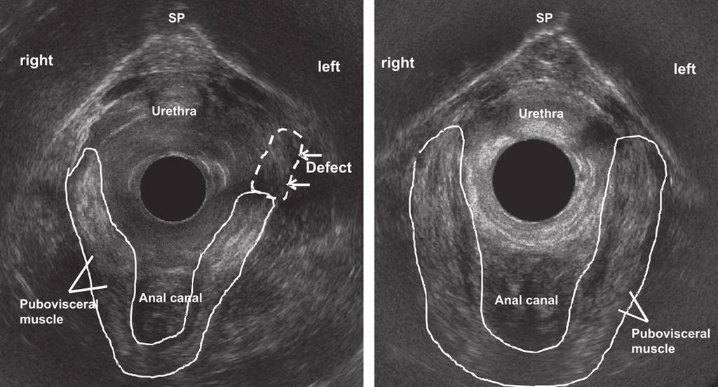 PVM defects and faecal incontinence after vaginal delivery S. M. Murad-Regadas et al. (a) (b) Figure 2 Three-dimensional (3D) endovaginal ultrasonography after vaginal delivery (axial plane).