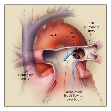 Potts anastomosis Anastomosis of the left pulmonary artery with the aorta Alternative to AS based on a similar physiological rationale: to increase systemic output and to decompress the RV The main