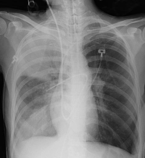Pulmonary artery perforation