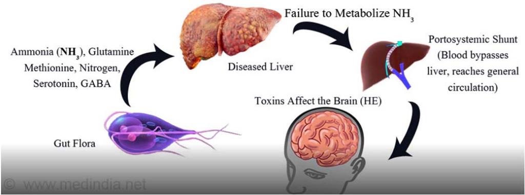 PATHOGENESIS OF HE Gut derived Ammonia: neurotoxin that precipitates HE CLASSIFICATION OF HE Underlying disease Type A: HE associated with acute liver injury Type B: HE associated with portal