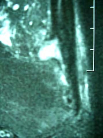 MRI used extensively Shows tendon Bursa Marrow