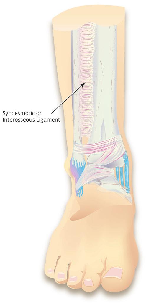 ligament. High Ankle Sprain A high ankle sprain injures the large ligament above the ankle that joins together the two bones of the lower leg.