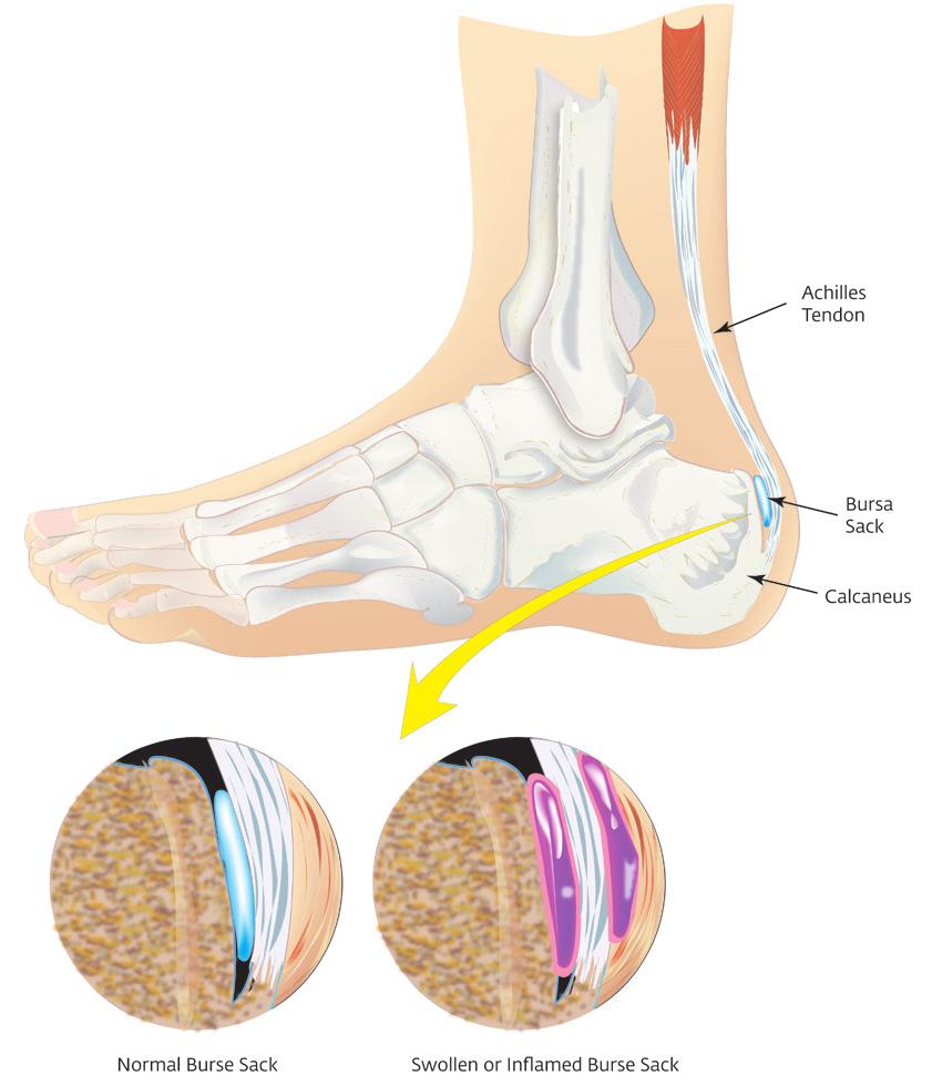 Achilles Tendonitis Achillies Tendonitis is an overuse injury usually characterized by a gradual onset of posterior ankle pain.