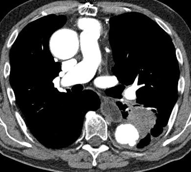 Contentious T3 Tumours < 3cm mediastinal contact Preserved fat planes