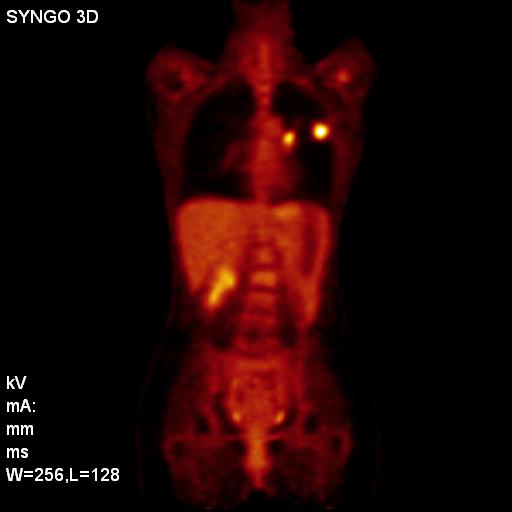 Nodal Staging Issues: Value of PET, PET/CT 50 patients NSCLC Nodal