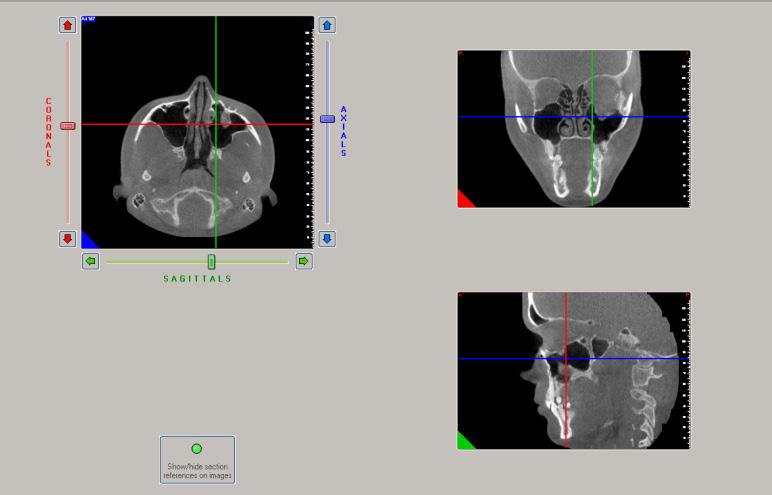 within the sinus [4]. Sagittal section plane on computer tomography (CT) was stated by several studies as the main plane to be able to appreciate correctly the orbital floor fractures.