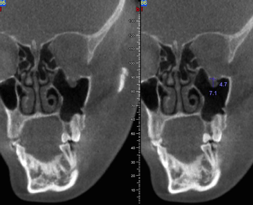 Sagittal section in an oblique extraction. Associated maxillary bone fracture Figure 8. CBCT.