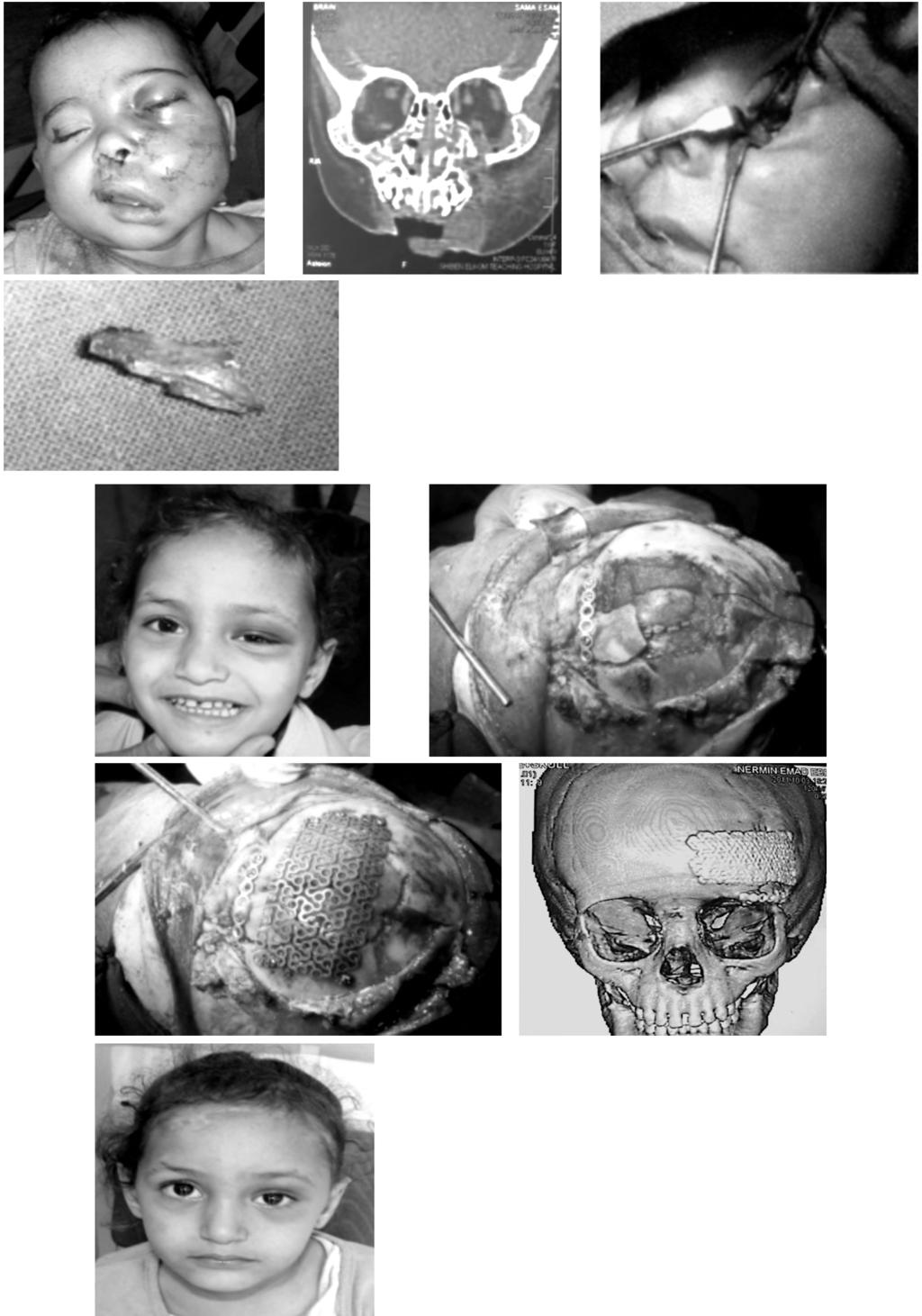 220 Pediatric Craniofacial Injuries: Concept of Treatment (B) (C) Fig. (4A-D): Six months female child sustained orbital fracture. (B) Coronal CT scan.