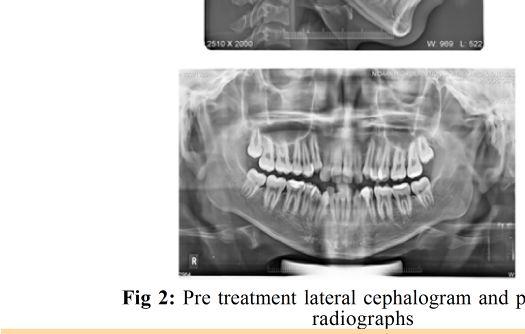 Intraorally, he had Class III molar and canine relationship bilaterally along with crowding of 8mm in maxilla and 10 mm in mandible. Overjet and overbite were -2mm and 2mm respectively [Fig 1].