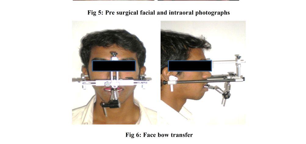 48 Fig 5: Pre surgical facial and intraoral
