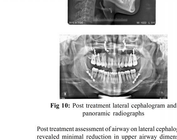 Post treatment AP [Fig 11] taken 6 months post surgery commensurate with cephalometric findings and showed minimal reduction in mean pharyngeal volume and mean pharyngeal area to 92% of pretreatment