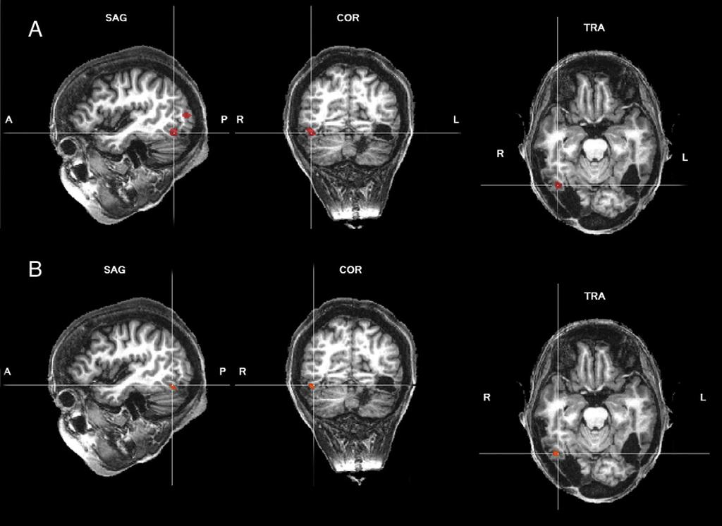 L. Dricot et al. / NeuroImage 40 (2008) 318 332 325 Fig. 5. Single subject analysis of patient PS in the fmri-adaptation block experiment 1. (A) Localization of the LOC: tn6, p(bonf) b0.
