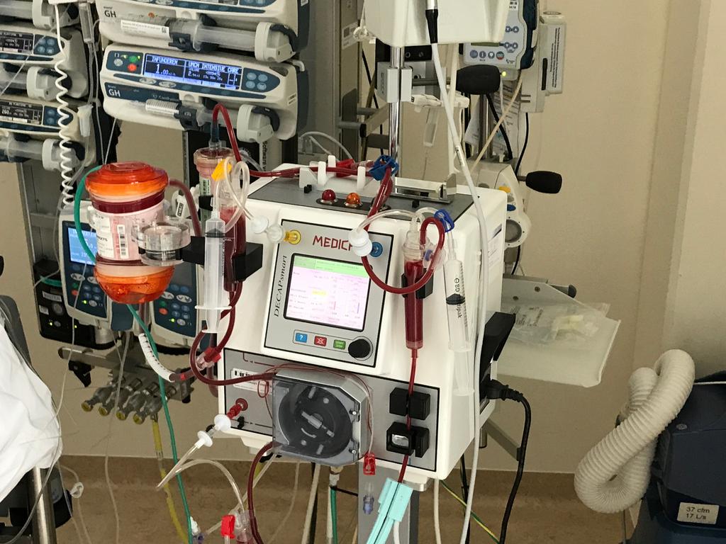 Extracorporeal CO2 removal Blood