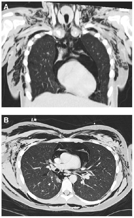 ECCO2R in acute severe asthma Rescue therapy in giant pneumomediastinum causing tamponade ( in stead of surgical decompression) using ultra protective MV Unsafe