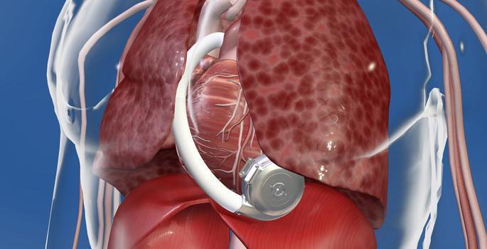 October 4, 2017 Medtronic HeartWare HVAD System APPROVED for