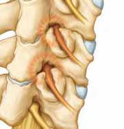 Overuse of the joint or a past injury can also lead to the disease.