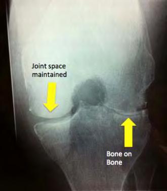 Load and Knee Joint Mechanics Altered load
