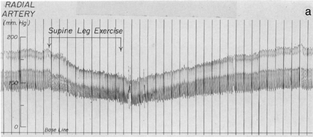 Original blood pressure tracing of one subject with exercise-induced hypotension (idiopathic orthostatic hypotension). Vertical lines are at 10-second intervals.