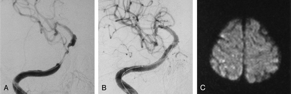 388 TSUMOTO AJNR: 26, February 2005 FIG 1. Case 2. A and B, Right ICA angiograms. Pretreatment image in A shows long segmental stenosis of the right C4 portion.