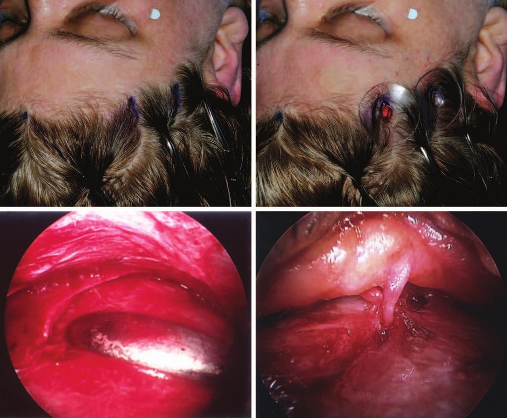 Plastic and Reconstructive Surgery April 2014 Fig. 2. Critical steps of site II surgery. (Above, left) Markings 7 cm and 10 cm from midline. (Above, right) Insertion of endoscopic access devices.