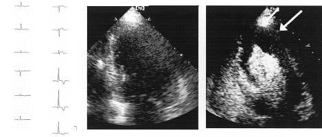 T 261 Fig. 1 Representative case of apical hypertrophy Left: Electrocardiogram showed negative T waves in V 4 V 6. Middle: Transthoracic echocardiogram failed to show apparent abnormalities.