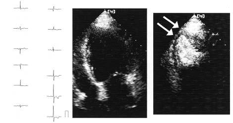 262 Fig. 3 Representative case of apical thinning associated with apical hypertrophy Left: Electrocardiogram showed negative T waves in V 4 V 6.