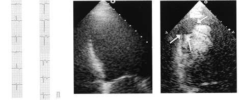 T 263 Fig. 4 Representative case of mural thrombus associated with apical asynergy Left: Electrocardiogram showed negative T waves in V 4 V 6.
