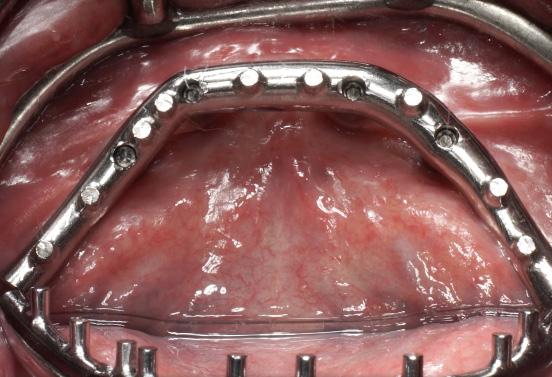 Course overview Treating fully edentulous patients has always been challenging yet modern dental implant solutions, such as Straumann Pro Arch, provide clinicians with a simplified and reliable way